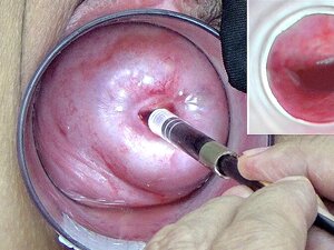 A Endoscope Japanese Camera Is Inserted In The Cervix To Watch Inside The Uterus. Porn